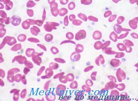 патологический гемоглобин