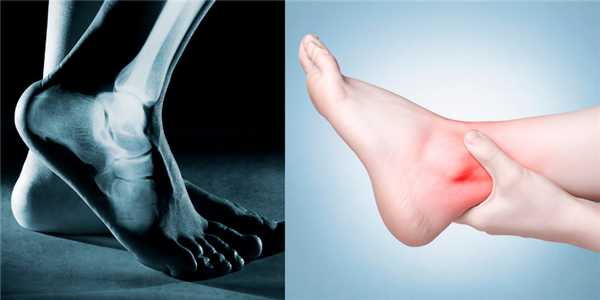 Артрит голеностопа