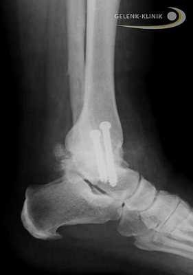 Артродез помогает восстановить безболезненность и потерянную подвижность. Данное вмешательство требует использования специальных винтов и интрамедуллярных гвоздей. Они фиксируют сустав до полной оссификации. © Gelenk-Klinik