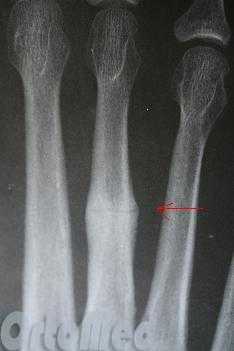 снимок перелома плюсневой кости стопы