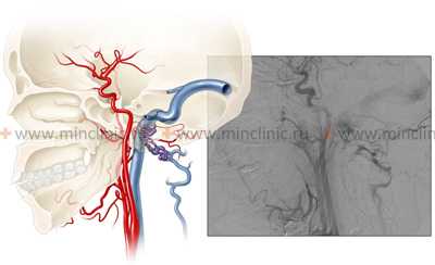 Процедура селективной церебральной ангиографии сосудов шеи (сонной артерии).