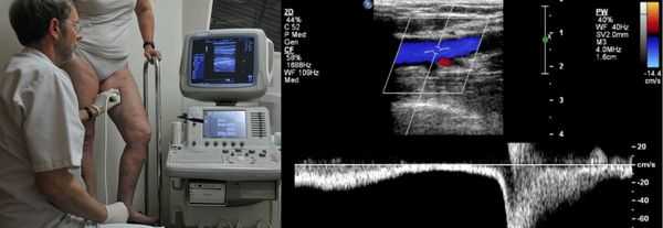 дуплексное ангиосканирование вен ног