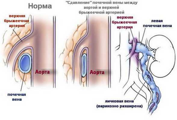 Аорто-мезентериальный пинцет