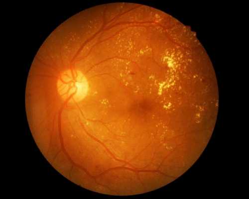 Диабетическая ретинопатия