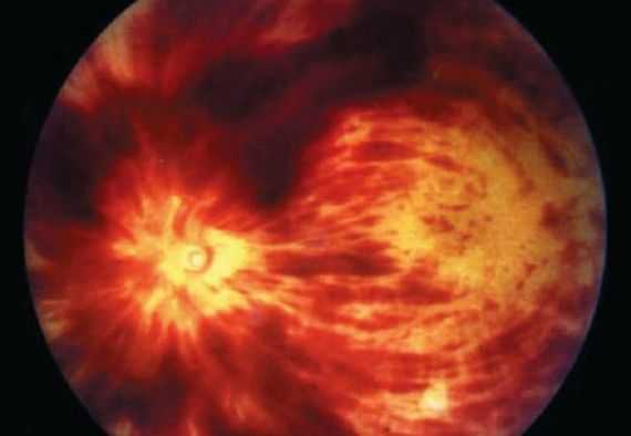 Офтальмоскопия, симптом «раздавленного помидора»