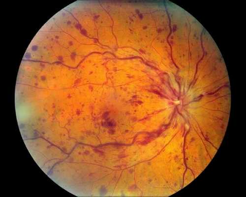 Окклюзия центральной вены сетчатки