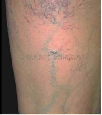 Ретикулярные вены и сосудистые звездочки