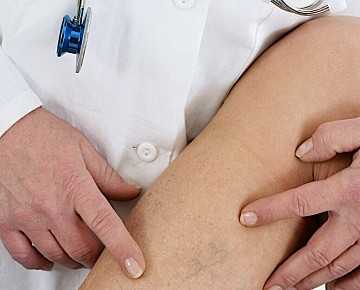 Фото Варикоз вен