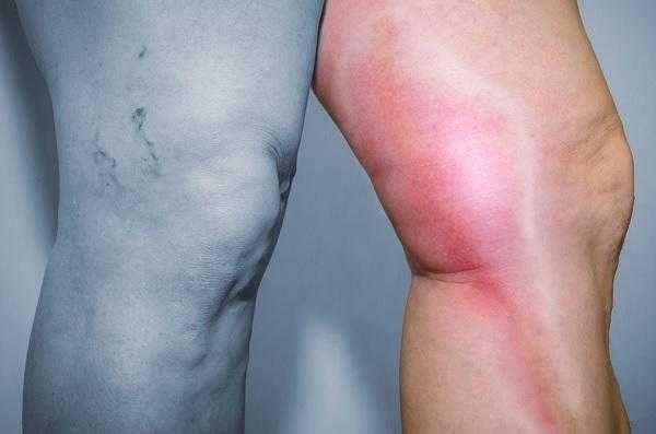 Острый тромбофлебит поверхностных вен