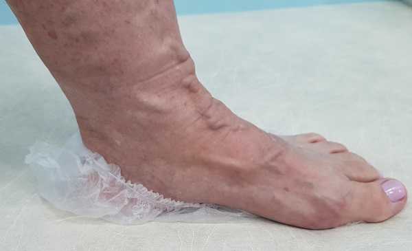 Так выглядят расширенные вены на стопе