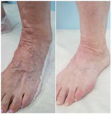 Результат ЭВЛК расширенных вен на стопе через 1 месяц