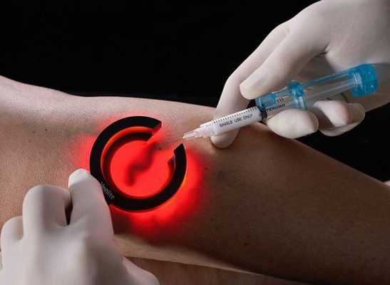 Диодная люминесцентная склеротерапия