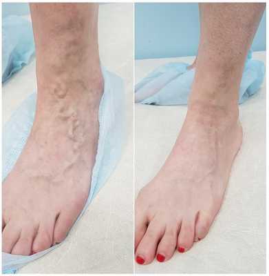 Результат удаления варикозных вен на тыле стопы с помощью лазерной технологии