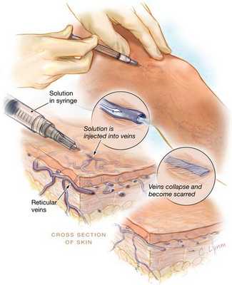 Склеротерапия