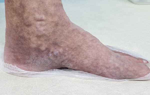 Запущенный варикоз вен на стопе