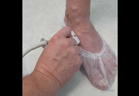 Ультразвуковая диагностика расширенных вен на стопе