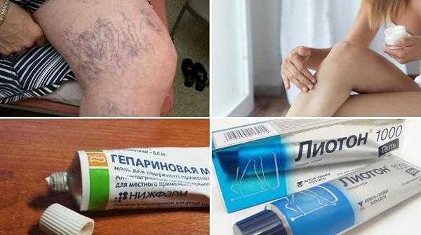 Лечение варикоза мазями и гелями
