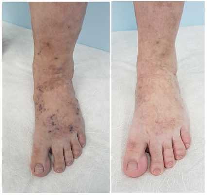 Результат склеротерапии сосудистых звездочек на стопе