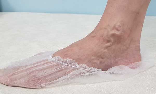 Варикозное расширение вен на стопе и в области лодыжки