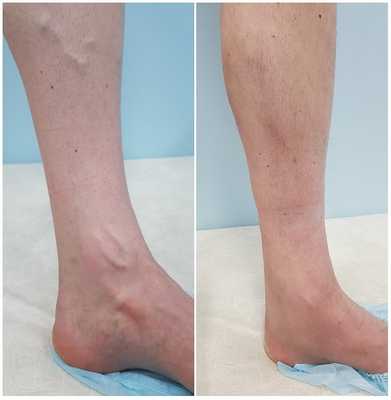 Результат лечения варикоза на стопе методом ЭВЛК в нашем центре