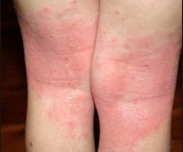 Фото Дерматит