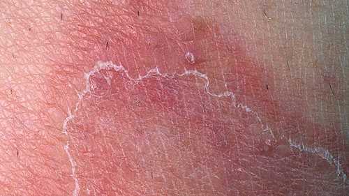 Лечение дерматита