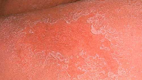 Варикозный дерматит 2 стадия