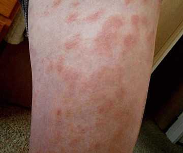 Фото Дерматит на ногах