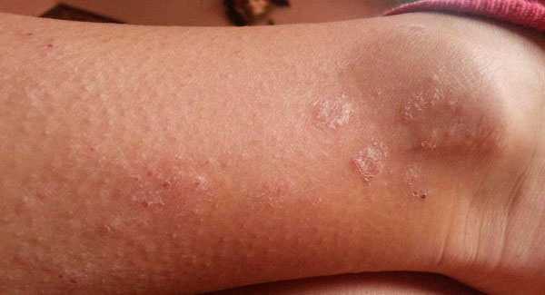 Варикозный дерматит