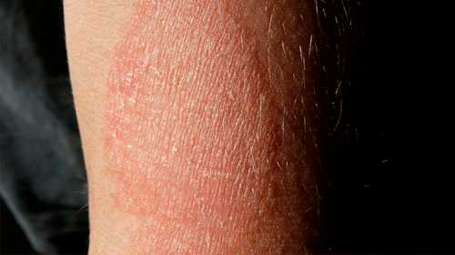 Варикозный дерматит 3 -я стадия