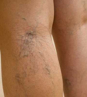 Фото Варикозный дерматит нижних конечностей