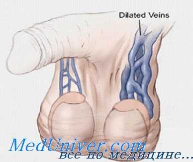 варикоцеле