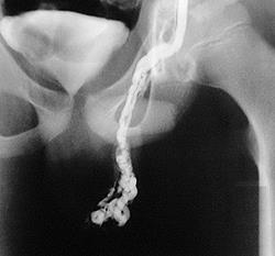 Тестикулярная венограмма. Варикоцеле