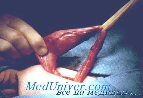 лечение варикоцеле