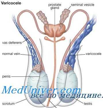 лечение варикоцеле
