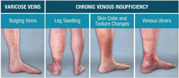 Симптомы хронической венозной недостаточности