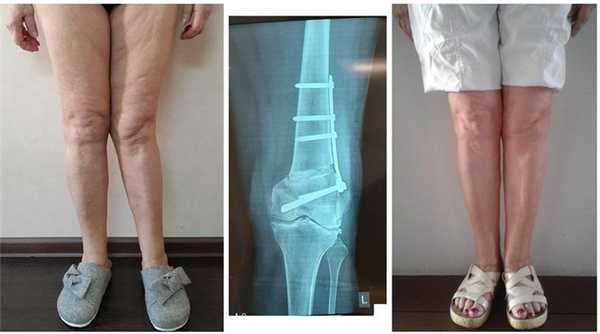 кривые ноги