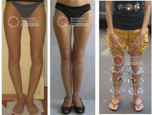 исправление кривизны ног