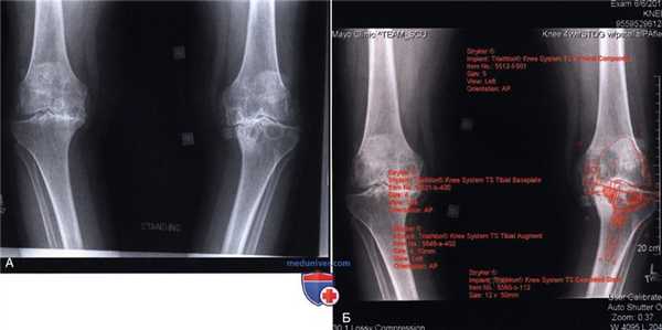 Показания, подготовка к тотальному эндопротезированию коленного сустава в условиях варусной деформации