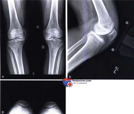 Показания, подготовка к тотальному эндопротезированию коленного сустава в условиях варусной деформации