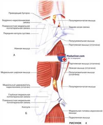 Показания, подготовка к тотальному эндопротезированию коленного сустава в условиях варусной деформации