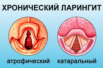 Типы хронического ларингита