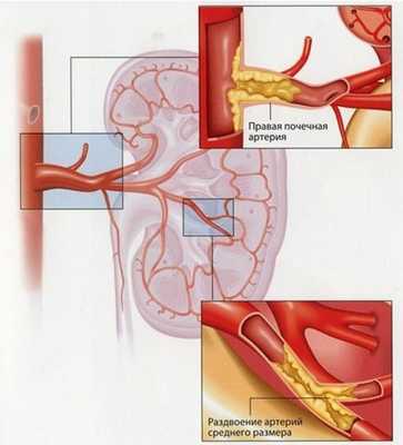 Бляшки в почечных артериях - одна из частых причин гипертонии