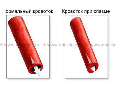 Сужение артерий головного мозга (церебральный вазоспазм) часто возникает в ответ на субарахноидальное кровоизлияние.