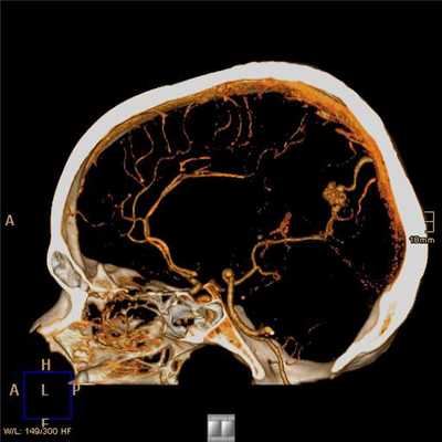 Кровоточащая артериовенозная мальформация головного мозга (АВМ), выявленная при КТ-ангиографии с контрастированием.