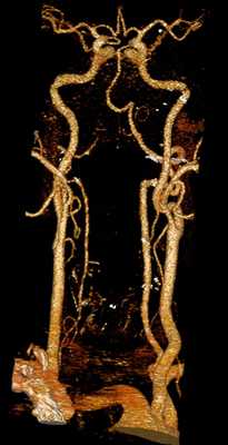 На компьютерной (КТ) ангиографии сосудов шеи и головного мозга показаны позвоночная и сонные артерии (вид спереди).