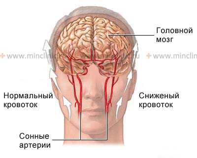 Сужение артерии головного мозга (церебральный вазоспазм) резко ухудшает общее клиническое состояние пациента.
