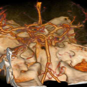 На компьютерной (КТ) ангиографии сосудов головного мозга показаны позвоночные и основаня артерия в задней черепной ямке (вид сзади).