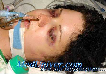 Ведение больных с послеоперационным паралитическим илеусом