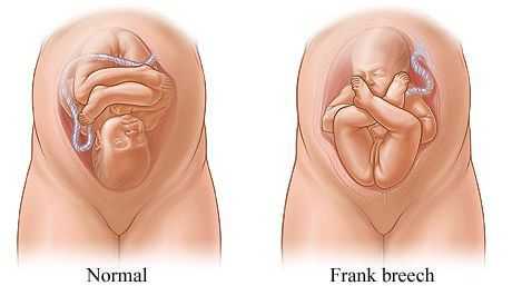 Нормальное и тазовое предлежание плода